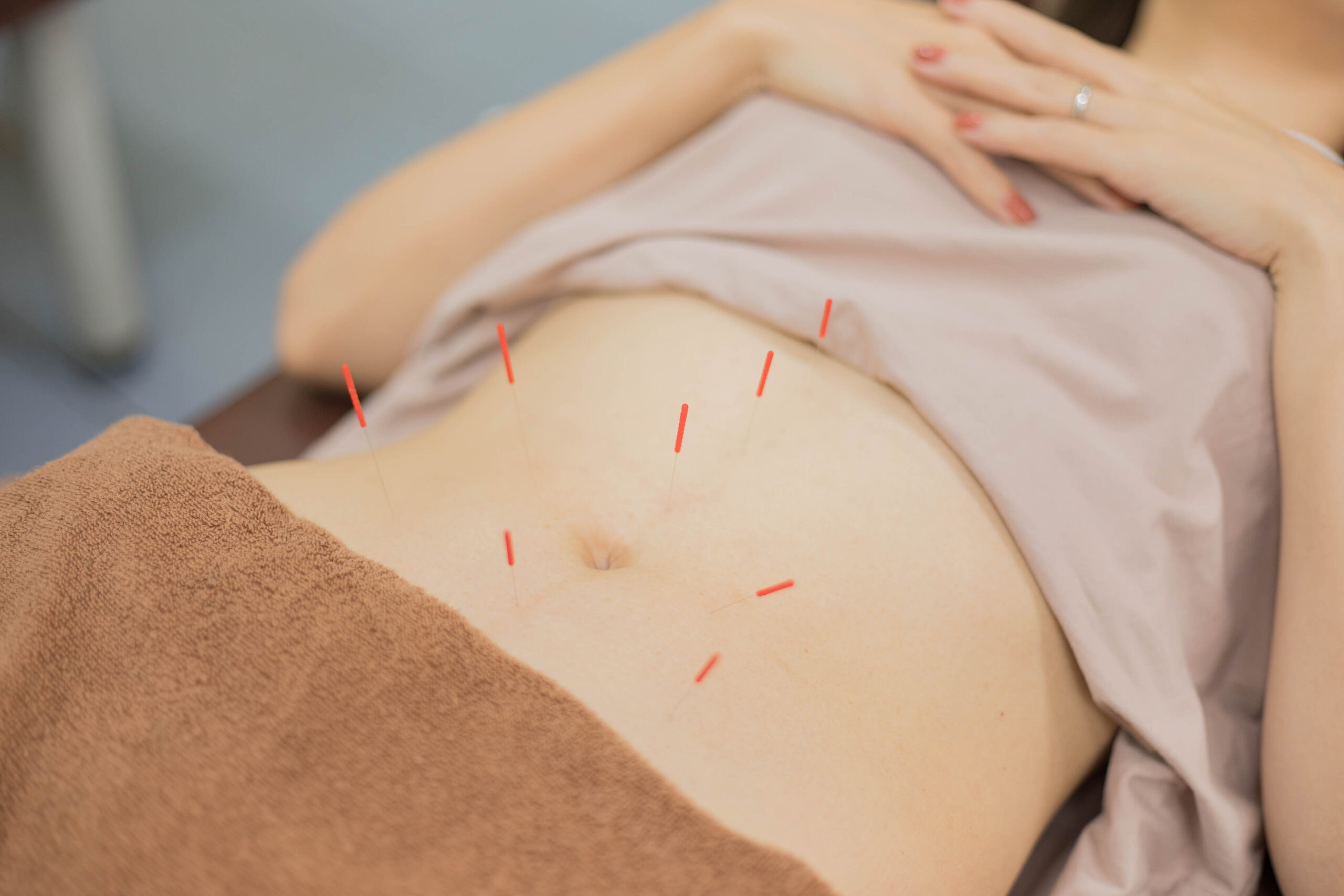 CMCはり施術｜荒川区の町屋中央整骨院