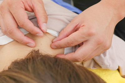 町屋中央整骨院での鍼施術の様子